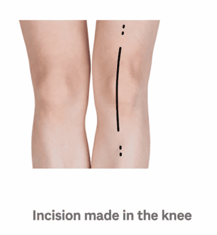 Incision made in the knee