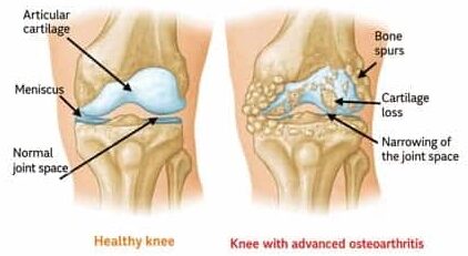 Osteoarthritis of the knee
