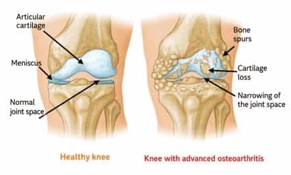 Osteoarthritis of the knee