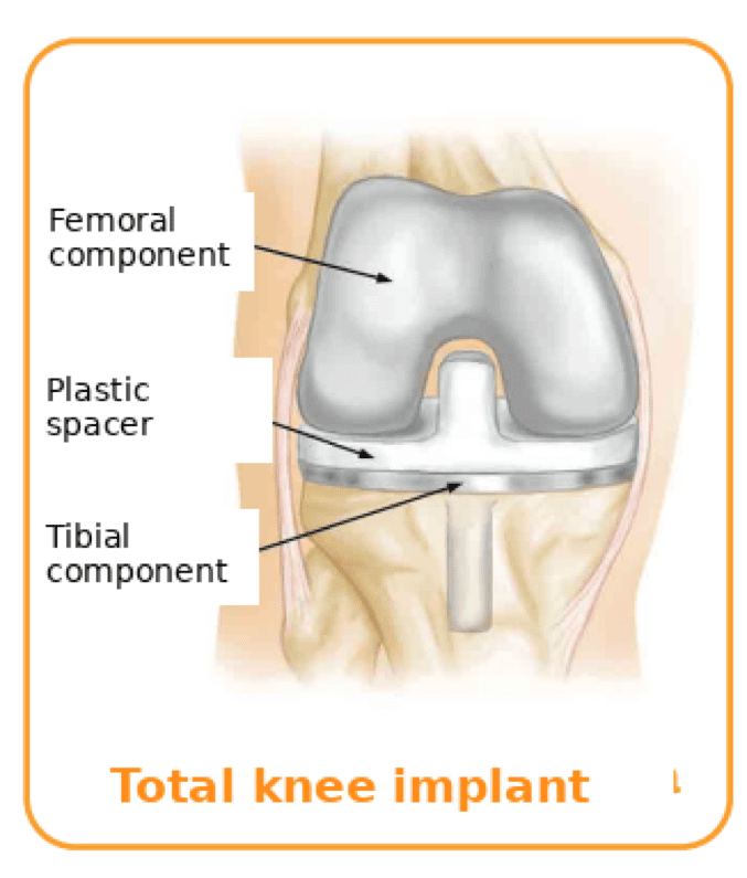 Total knee implant